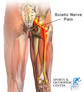 Sciatica pain