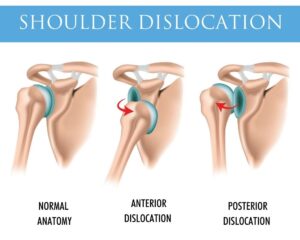 ARTHROSCOPIC SHOULDER DISLOCATION REPAIR